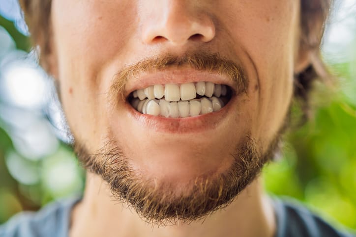 Man placing a bite plate in his mouth to protect his teeth at night from grinding caused by bruxism.